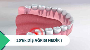 20 lik Diş Ağrısı Nedir? Nasıl Tedavi Edilir?