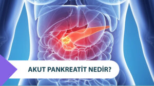 Akut Pankreatit Nedir ? Kendiliğinden Geçer Mi ?