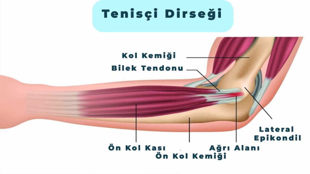 Tenisçi dirseği (lateral epikondilit ) Anatomik Görüntüsü