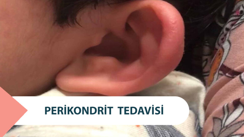 Perikondrit - Kulak Kepçesi İltihabı Tedavisi