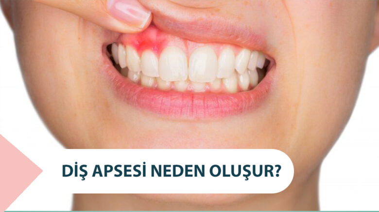 Diş Apsesi Neden Oluşur? Nasıl Tedavi Edilir? 