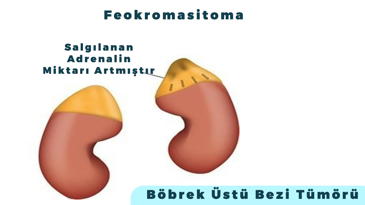 feokromasitoma