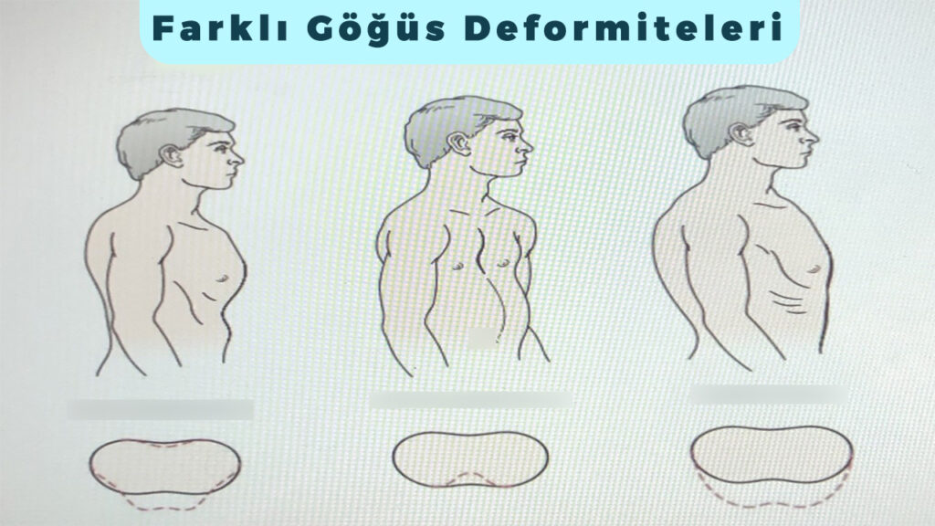 Farklı Göğüs Deformiteleri