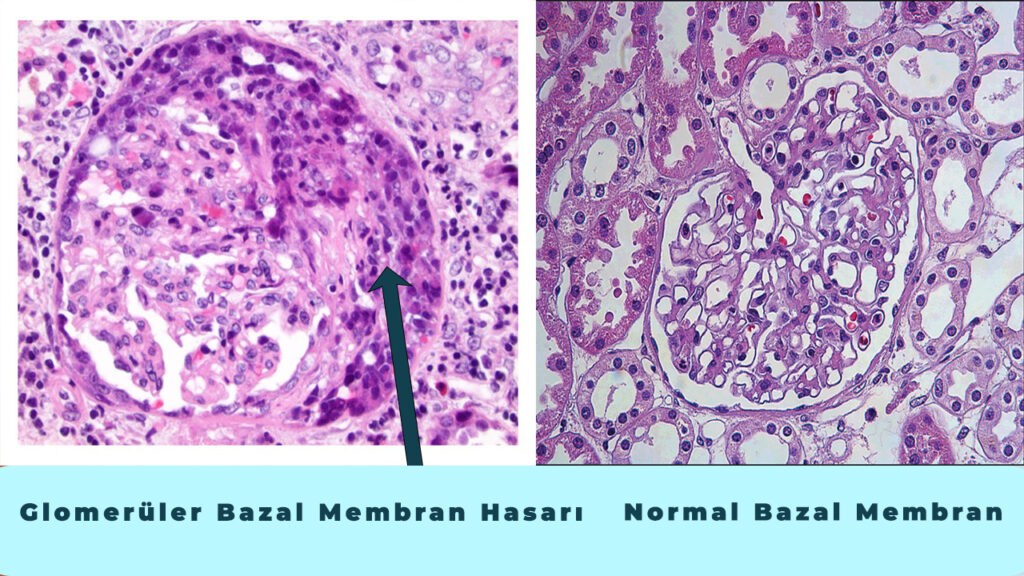 glomerül bazal membran hasarı ve normal bazal membran Goodpasture histolojik görüntü