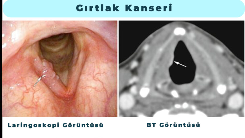 gırtlak kanseri laringoskopi görüntüsü ve bt görüntüsü