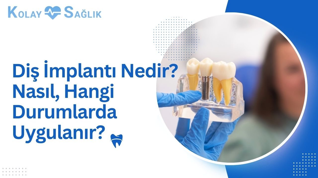 İmplant Diş Nedir? İmplant Diş Nasıl Yapılır?