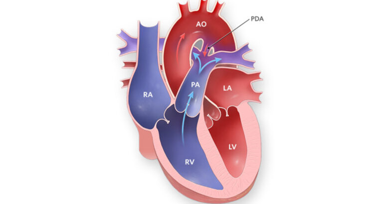pda nedir